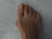 Nuove frontiere nel trattamento dell’alluce valgo e delle altre deformità del piede