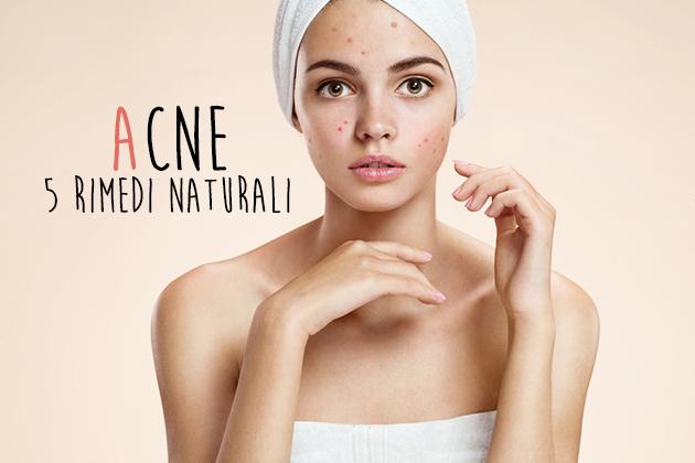 5 rimedi naturali contro l'acne