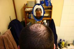 Dal sangue una speranza per l’alopecia