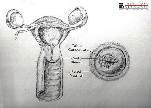 Fibromi uterini e gravidanza