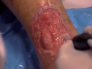 Figure 2. At the end of an ultrasonic debridement of a phlebostatic ulcer.