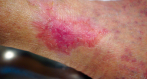Figure 8. Final closure of the lesion after 135 days of treatment.